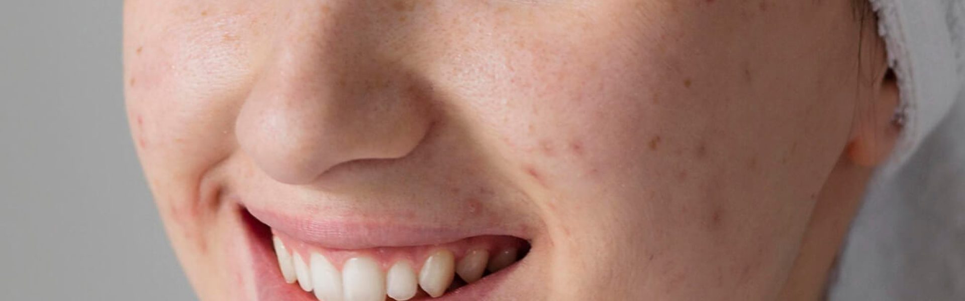 clarity-smiley-woman-with-acne-posing
